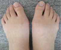 Big toe curved inward deals no bunion