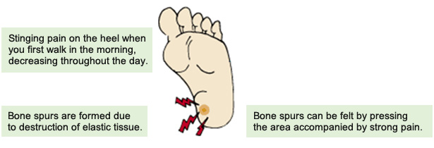 Heel pain (Bone spur on calcaneal bone 